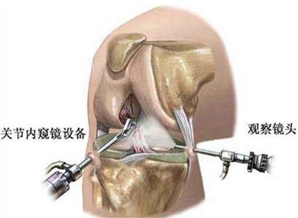 关节镜动力刨削